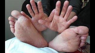 COXSACKIE VIRUS Symptoms Causes Transmission Treatment Hand Foot Mouth disease Herpangina [upl. by Grodin]