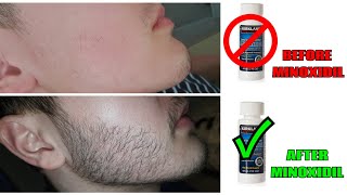 Growing a Beard from Nothing  Minoxidil Beard Transformation  Full 2020 Timeline [upl. by Adnahcir]