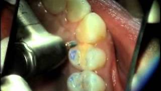 V3105  Uncomplicated Occlusal Equilibration [upl. by Torrell]