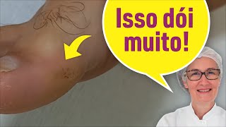 É OLHO DE PEIXE OU CALO O QUE VOCÊ ACHA [upl. by Enaols]