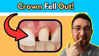 What to do if your Crown Falls out Dentist Explains [upl. by Nodle]