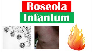 Roseola Infantum Sixth Disease  Symptoms Fever amp Rash in Infants Diagnosis Treatment [upl. by Elleirol]