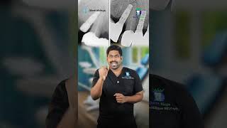 பதியம் செய்த பல்லை கழட்ட முடியுமா  Can we remove the dental implants DrKarthikeyan  Denta Kings [upl. by Rothberg297]