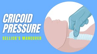 Cricoid pressure  Technique [upl. by Rance]