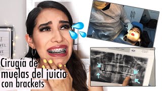 Mi experiencia con brackets 6  CIRUGÍA DE MUELAS DEL JUICIO Cirugía de Cordales Carel Quezada [upl. by Yee]