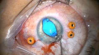 Coloboma Surgery [upl. by Chantal]