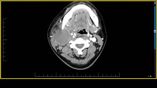 Salivary Glands  Mucoepidermoid Carcinoma [upl. by Jaffe]