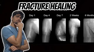 Fracture healing  Primary Vs Secondary healing amp Woven Vs Lamellar bone [upl. by Sitelc172]