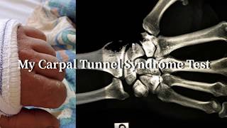 Carpal Tunnel Electromyogram test cts of the median nerve [upl. by Carrissa]