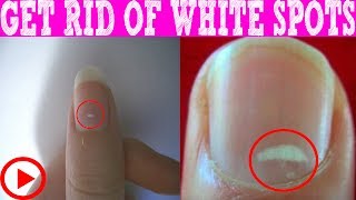 How to Get Rid of White Spots on Nails within 3 days  White Spots On Nails What It Really Means [upl. by Moyra230]