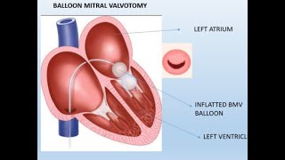 Mitral valve balloon valvuloplasty in MS patients [upl. by Bertasi]