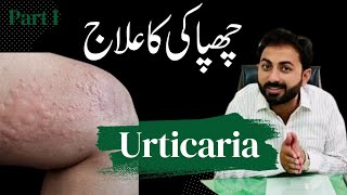 Types of Urticaria amp Homeopathy Treatment [upl. by Ynamrej]