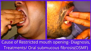 Cause of Restricted mouth opening or Trismus Causes Diagnosis Treatments Oral submucous fibrosis [upl. by Llirret]