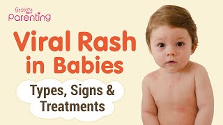 Common Viral Rashes in Babies  Types Signs and Treatement [upl. by Hewart]