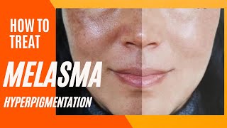 Melasma Removal at Home I Melasma Remove cream I Melasma Skin Care Regimen Routine [upl. by Aveline]