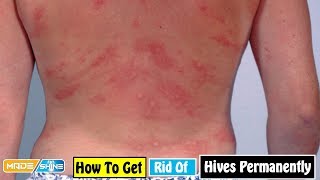 How to Get Rid of Hives Permanently  Home Remedies For Hives Symptoms [upl. by Selmore]