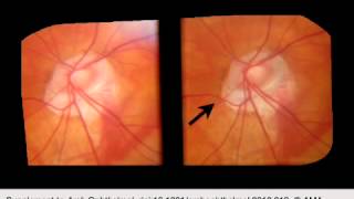 Detection of Progressive Glaucomatous Optic Neuropathy Using Automated Alternation Flicker With Ster [upl. by Hey]