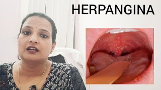 HERPANGINA throat ulcers in kids with high fever precautions and treatment [upl. by Karlens]