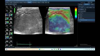 IQ 279 LIVER ULTRASOUND HEPATOMA ECHOPAC ANALYSIS ECHOCARDIOGRAPHY ELASTOGRAPHY 2 [upl. by Rosalee]