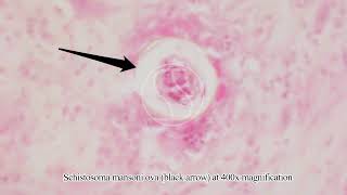 Schistosoma mansoni Ova Egg in Tissue with Haematoxylin and Eosin HampE Stain [upl. by Ileray]