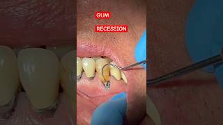 GUM RECESSION Cavity CL 5 Cavities  Tooth Vlog [upl. by Ienttirb602]