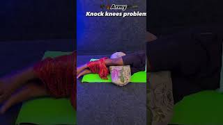 knock knees problem solution best tips [upl. by Beebe]