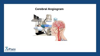 Cerebral Angiogram [upl. by Nibuz962]