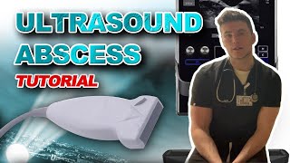 Ultrasound Guided Abscess Drainage [upl. by Berneta]