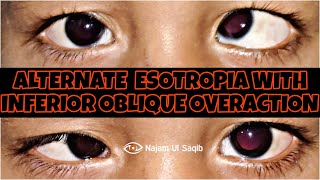 SquintStrabismus Examination  Alternate Esotropia With Inferior Oblique Overaction [upl. by Nirat302]