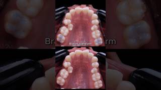 Braces transformation  crooked teeth not extraction braces orthodontist bracesoff dentist [upl. by Robbert]