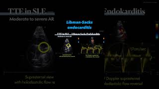 Libman Sacks endocarditis🫀 [upl. by Virgil]