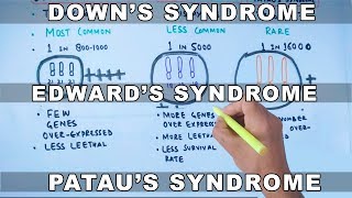 Trisomy  Downs vs Edwards vs Pataus Syndrome [upl. by Caylor]