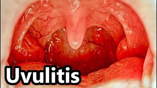 🔴 UVULITIS [upl. by Jasun]