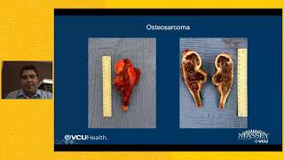 Sarcoma A Forgotten Cancer [upl. by Rese]