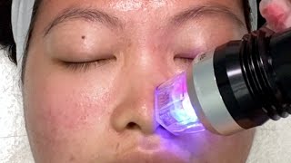 I Tried Microneedling RF for Acne Scars Before and After  East Asian Skin [upl. by Ayadahs]