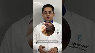 Does Minoxidil causes side effects for beard growth Listen to Beard specialist Advice [upl. by Llerred]