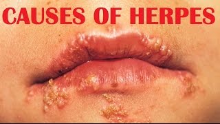 Herpes Simplex Virus  causes symptoms and treatment [upl. by Llerrah]