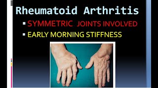 Pathology 860 Rheumatoid Arthritis Hladr4 hladr1 ankylosis pannus rheumatoid factor [upl. by Peck]