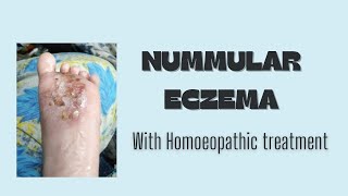 Numular eczema [upl. by Thorlay]