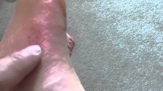 Discover How to Immediate Fix Pain and Swelling from Insect Bite Hamilton New Zealand [upl. by Alyce]