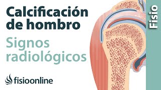 Calcificación de hombro en manguito rotador Signos radiológicos [upl. by Tirb]