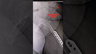 Hip trochanteric fracturevairalvideo anatomy radiology [upl. by Dougy559]