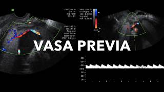 TMT Fetal Imaging by Dr Alpana Joshi Vasa Previa [upl. by Mcnair]