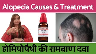 Alopecia Areata treatment  alopecia ka ilaj  alopecia areata homeopathic treatment in hindi [upl. by Adla]