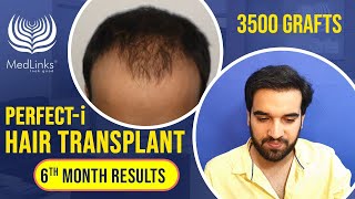 🔥Amazing Hair Transplant Results in India  Patient Testimonial Before and After Results [upl. by Ecnatsnoc]