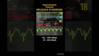 Brugada Syndrome  Hyponatremia Induced [upl. by Esiuqram]