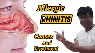 Allergic Rhinitis Causes and Treatment [upl. by Icnarf]