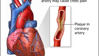 Prinzmetal angina symptoms amp treatment [upl. by Bowe]