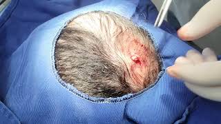 Scalp Cyst Exeresis [upl. by Ydok660]