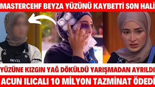 Masterchef Beyzanın Yüzüne Kızgın Yağ Döküldü Son Hali Acun Ilıcalı Tazminat BEYZA YARIŞMADAN ELENDİ [upl. by Eisenhart372]